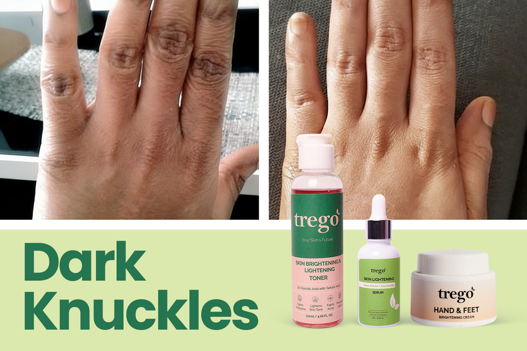 Dark Knuckles: Causes, Treatment & Effective Skincare Remedies
