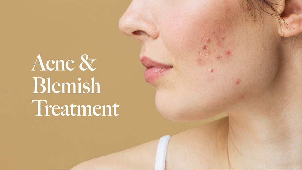 What are Blemishes? Causes, Types, and How to Treat Blemished Skin