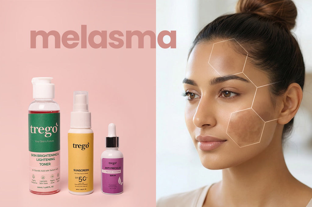 Melasma Treatment: Causes, Best Treatment for Face & Natural Cure
